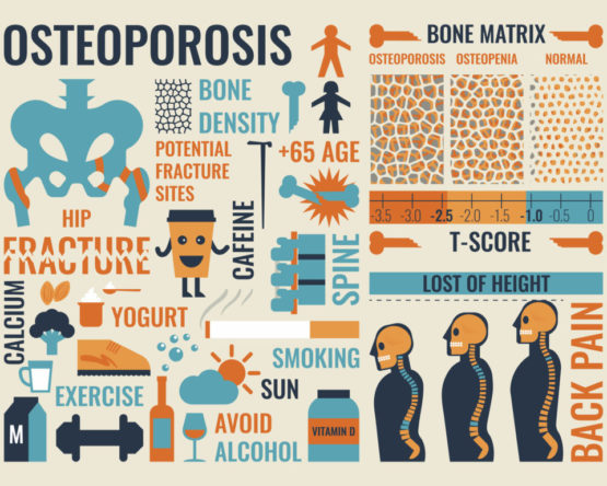 44274312 - illustration of osteoporosis infographic icon